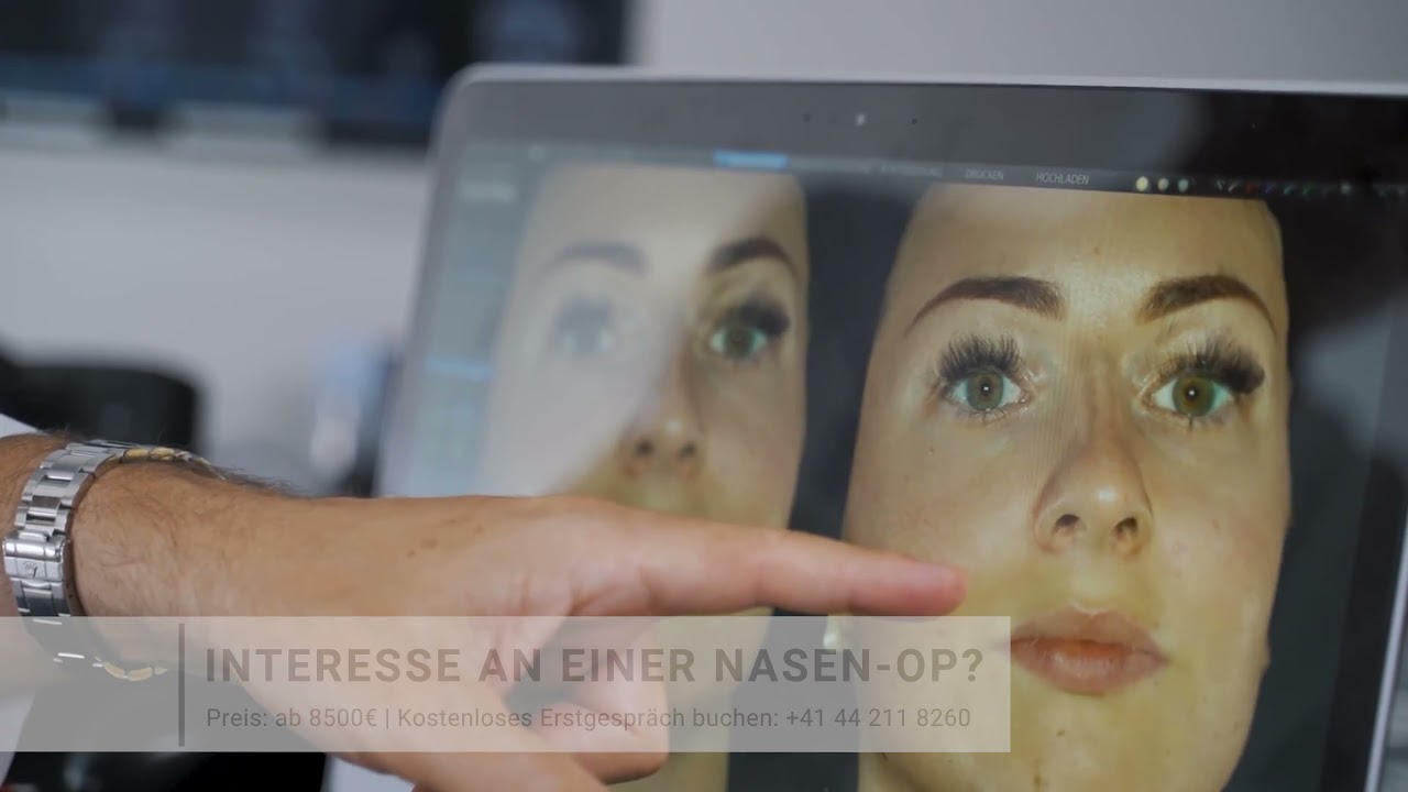 Nur den HÖCKER der Nase operieren. Ist das möglich?  | Dr. Stergiou - Schönheitschirurgie
