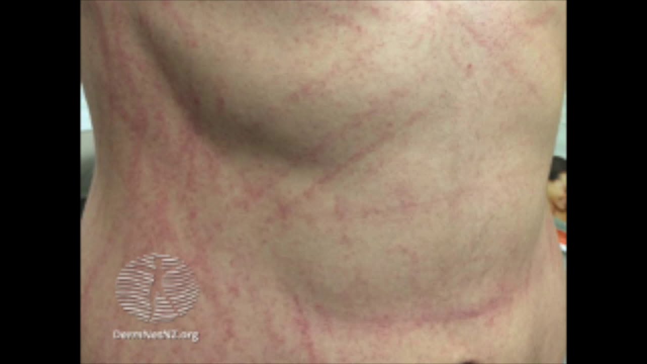 Flagellate Erythema (MEDSKL)