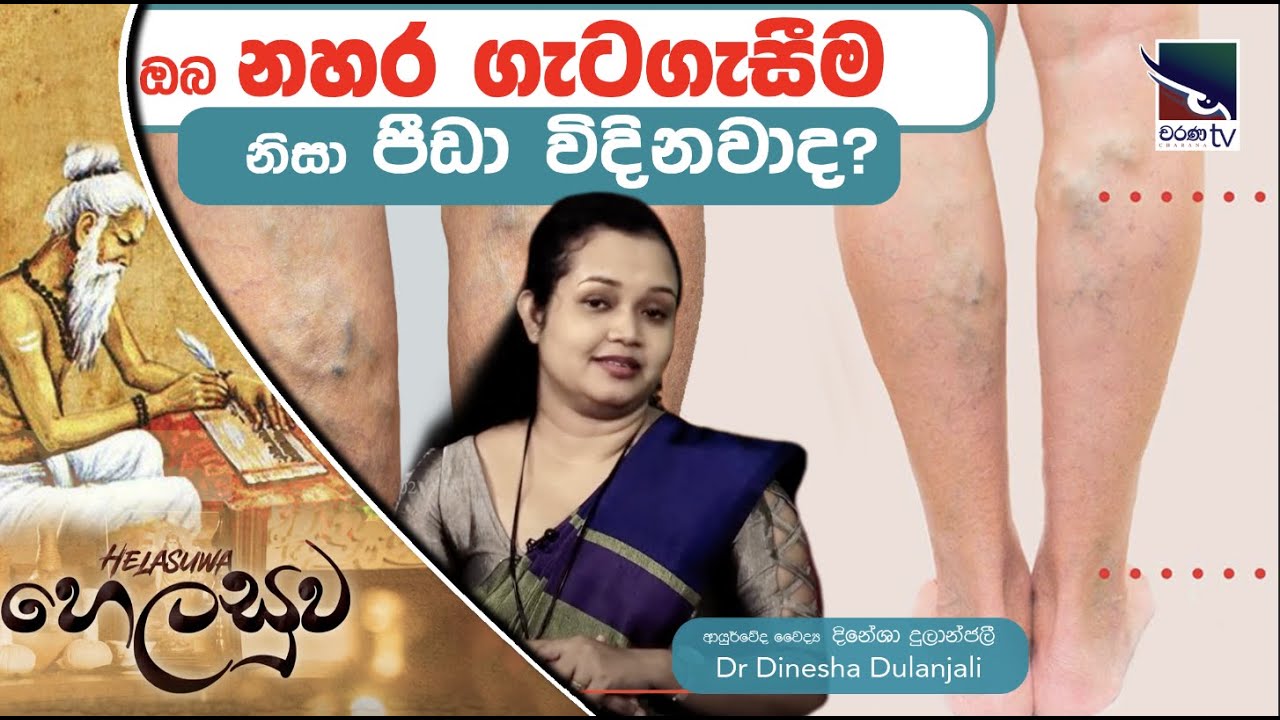 ඔබත් නහර ගැටගැසීම නිසා පීඩා විදිනවාද? ( varicose veins )