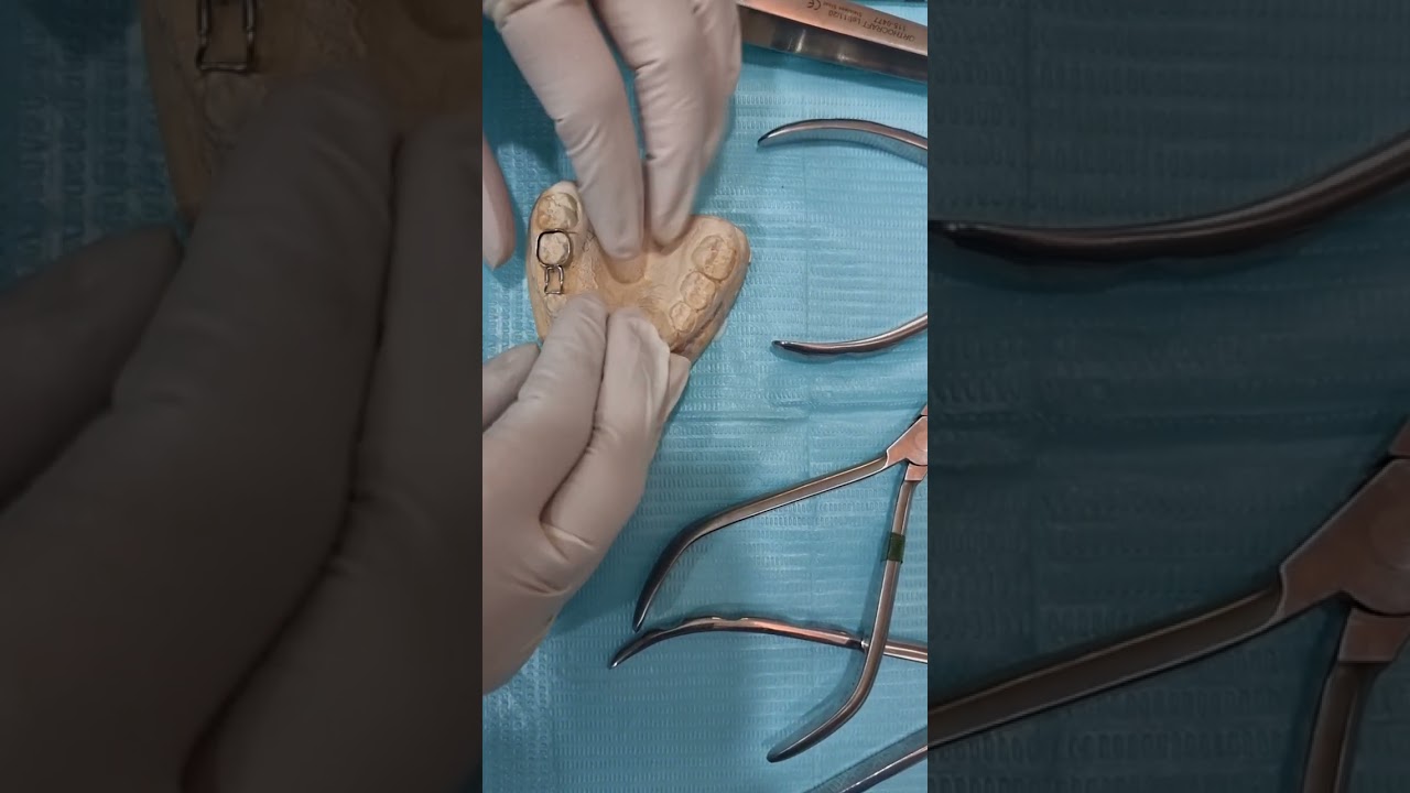 Preformed space maintainer in pediatric dentistry