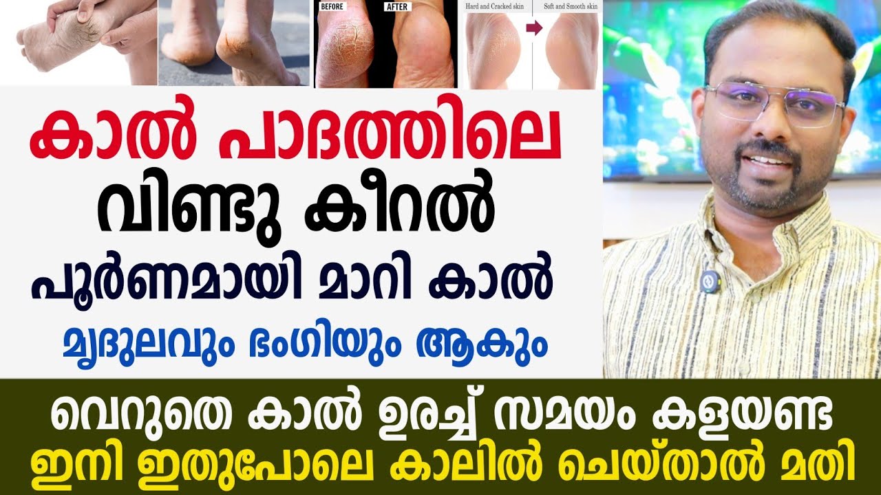 കാൽ പാദം വിണ്ട് കീറൽ പൂർണമായി മാറി കാൽ മൃദുലവും ഭംഗിയും ആകാൻ | Crack heels home remedies malayalam