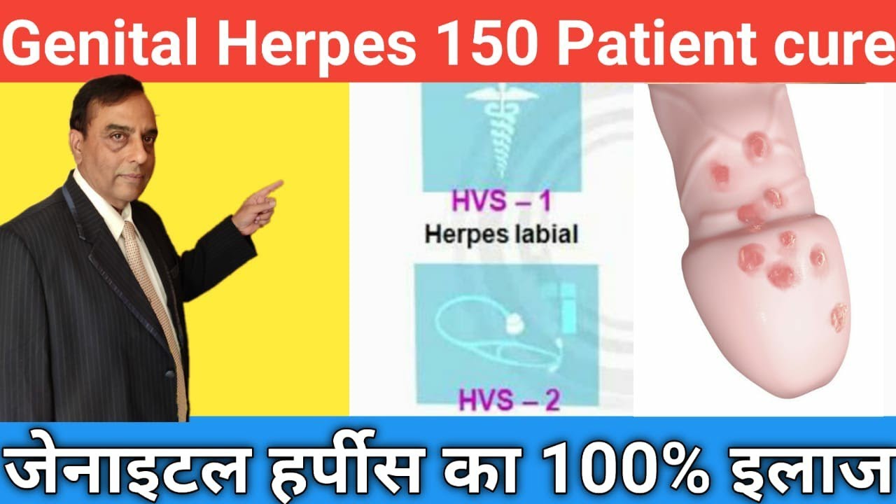 How To Cure Genital Herpes l HSV1 Positive and HSV2 Positive Cure 100% Treatment