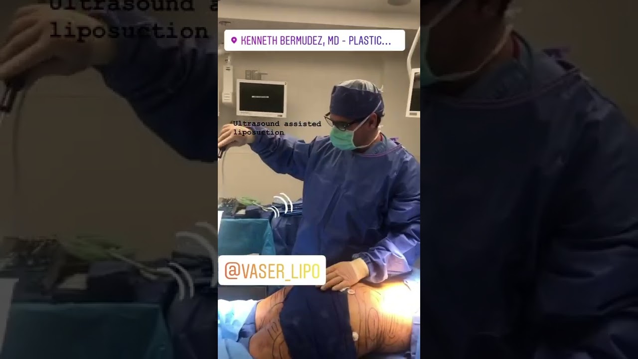 VASER ULTRASOUND ASSISTED LIPOSUCTION