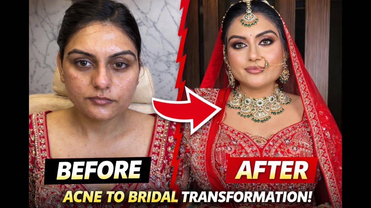 HD Bridal Base Kaise Banaye (Acne & Dry Skin) | Indian Bridal Makeup Tutorial