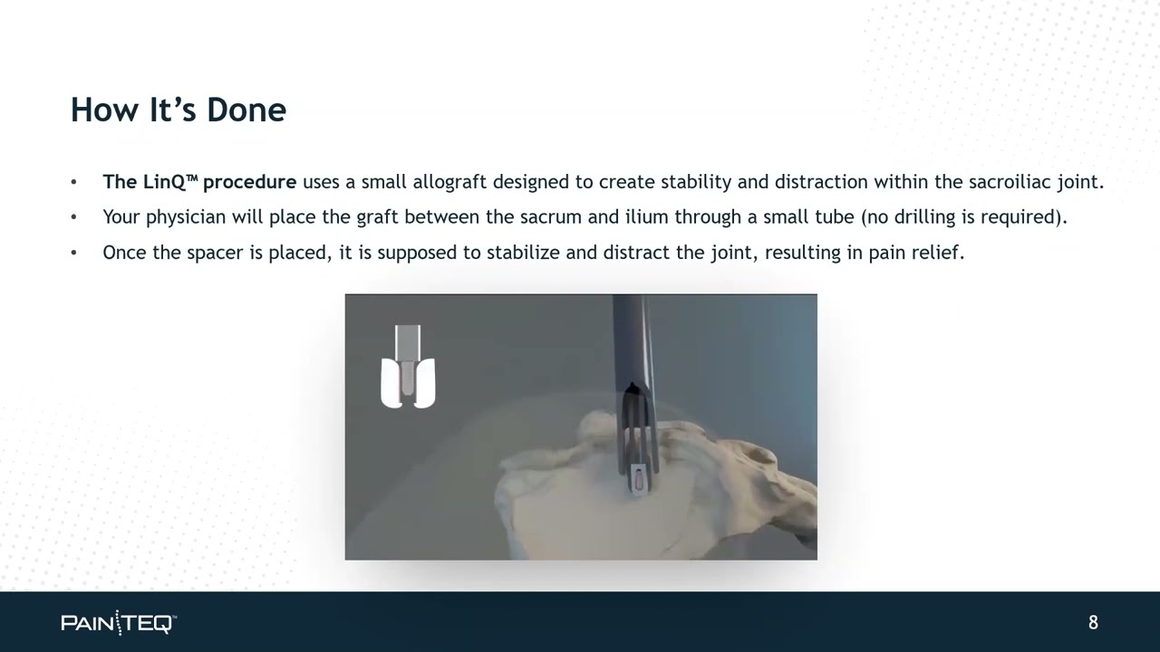 Webinar : New Option to Treat Low Back and SI Joint Pain | PainTEQ