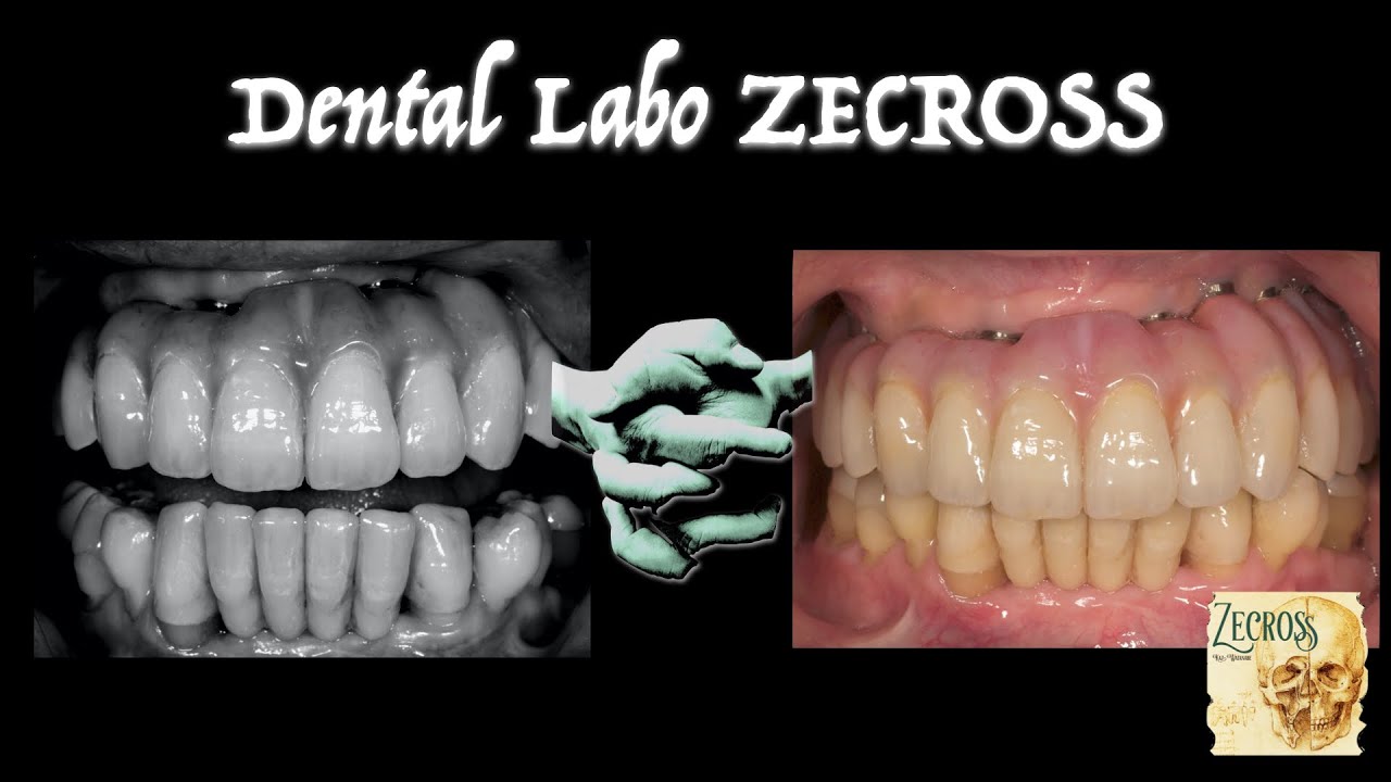 上顎フルマウス　インプラント　ISUS+e.max　下顎前歯ブリッジ、臼歯アンレー #インプラント　#dental implant #Zirconia #dental ceramic #e.max