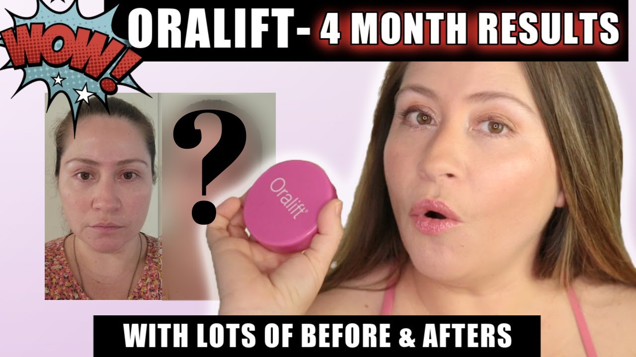 ORALIFT - MY 4 MONTH RESULTS | LOTS OF BEFORE & AFTERS