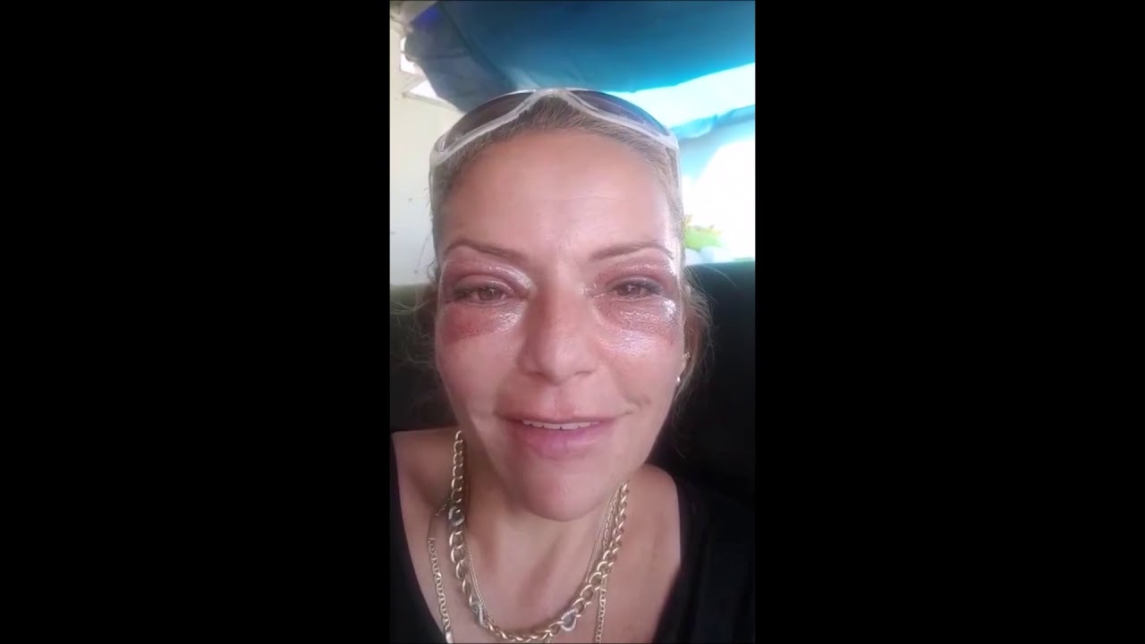 פלזמה הרמת עפעפיים ללא ניתוח - שלבי החלמה