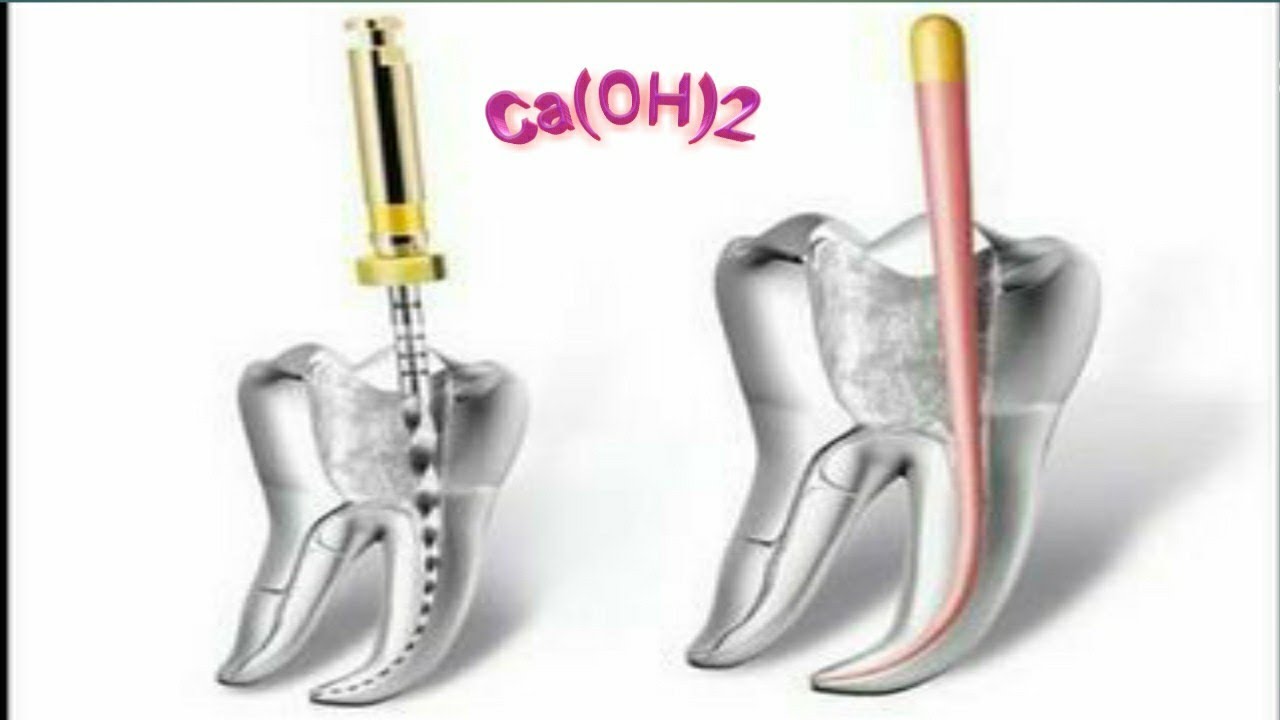 Ca(OH)2 using in root canal treatment with Dr-dawod ayad