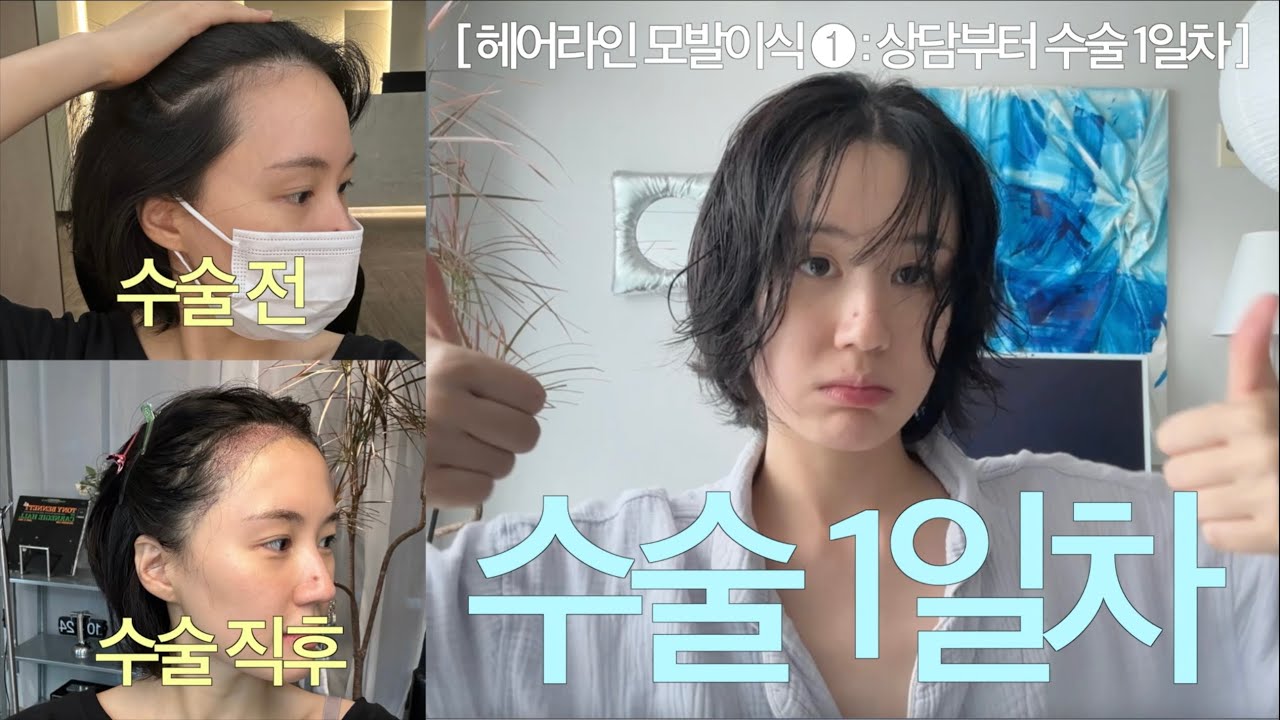 헤어라인 모발이식 리얼후기 1편 (상담부터 수술 당일 그리고 1일차까지)