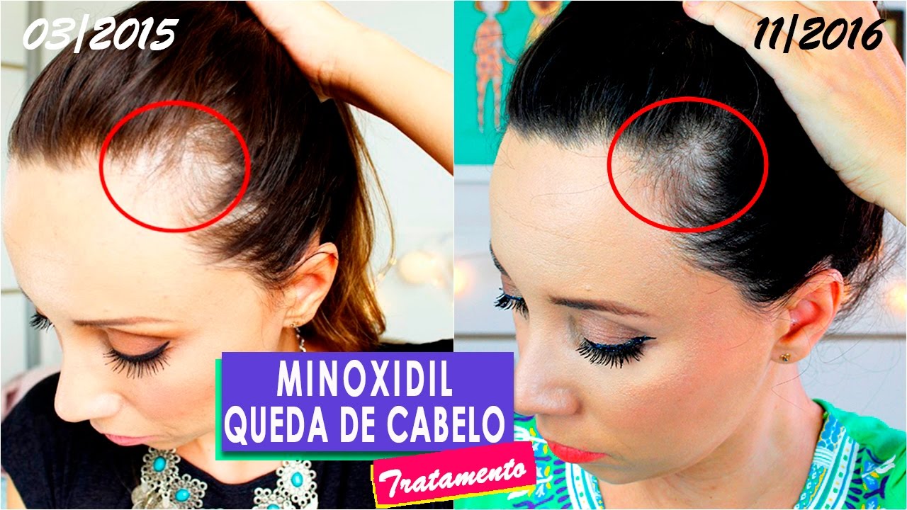 MINOXIDIL: 2 ANOS DE TRATAMENTO por Virgínia Gaya