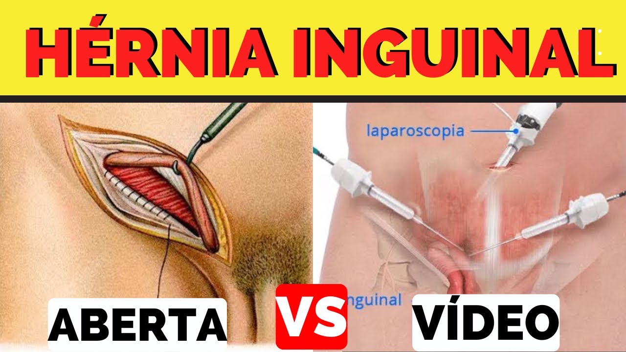 CIRURGIA DE HÉRNIA INGUINAL ABERTA OU CIRURGIA DE HÉRNIA INGUINAL POR VÍDEO?