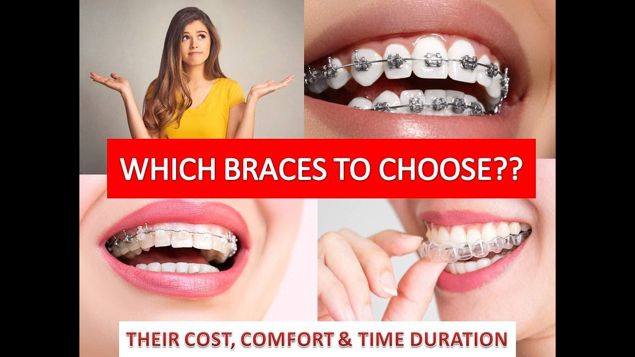 COST OF BRACES IN INDIA | BRACES FOR TEETH | MUST WATCH | TYPES OF BRACES | IN HINDI |