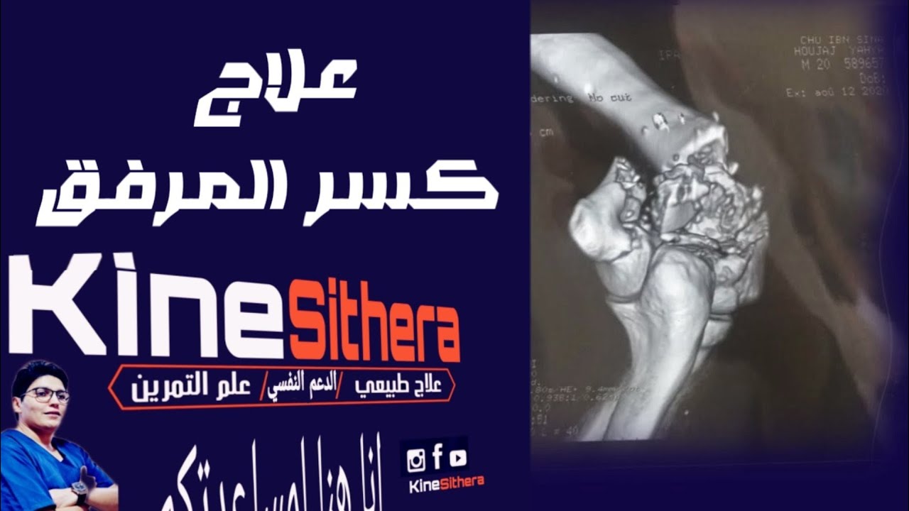 اسهل طريقة لعلاج كسر المرفق في المنزل