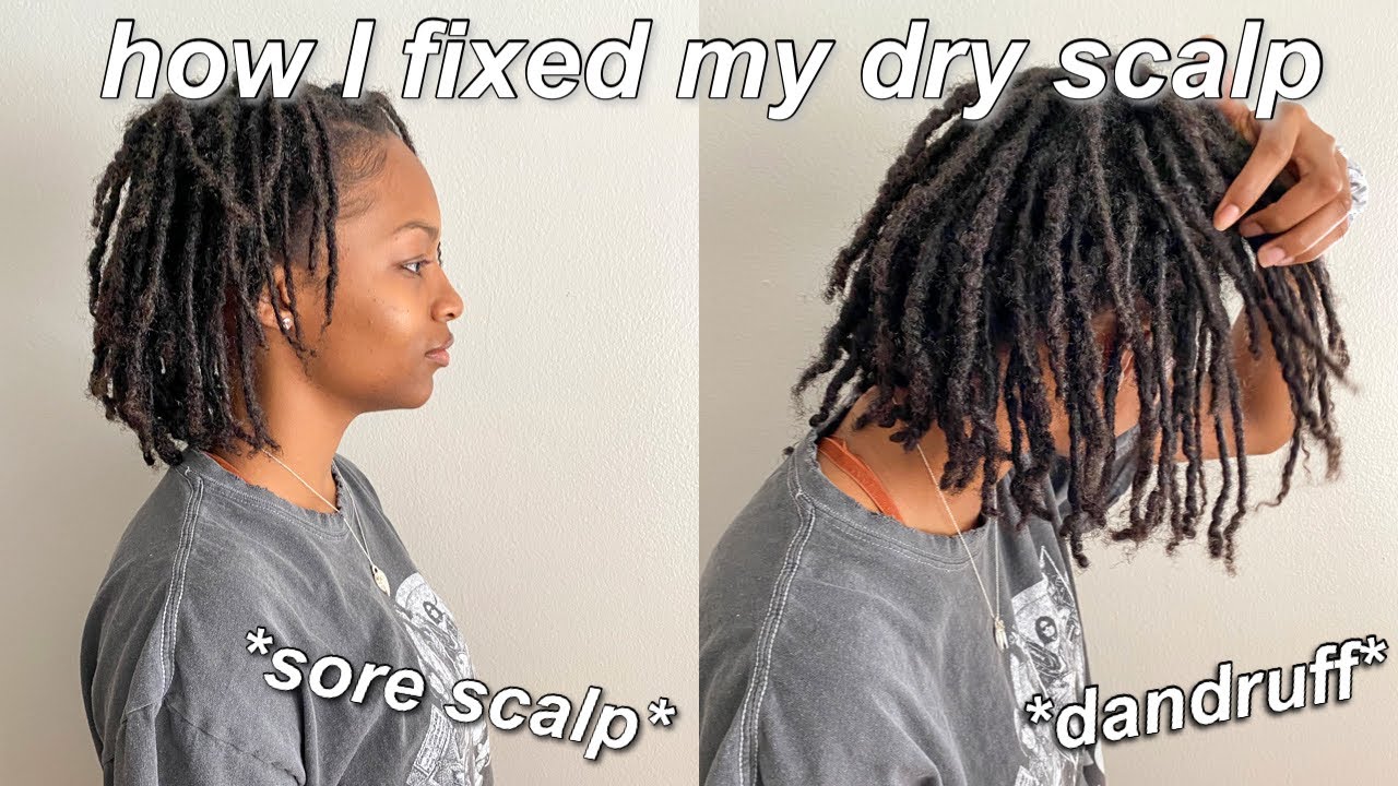 HOW TO GET RID OF DRY SCALP WITH LOCS ? | Dry Scalp Loc Crisis + Sensitive Locs 😩