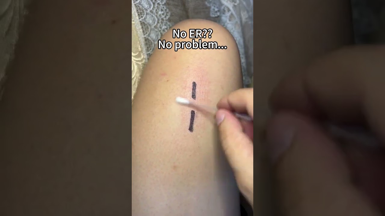Небольшой порез может случиться где угодно. Дома. В дороге. На улице. #senvok #перваяпомощь #закр...