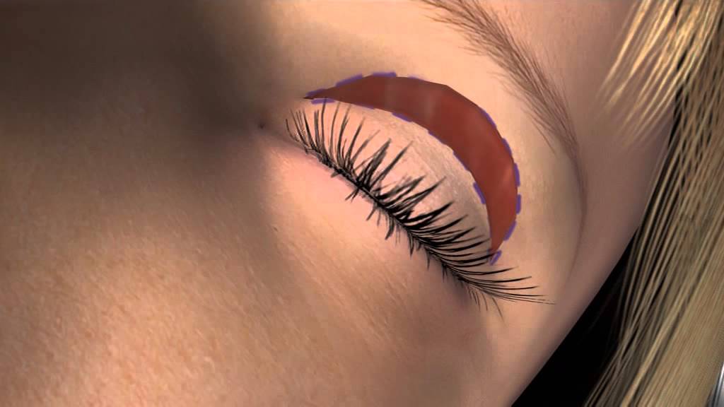 Bovenooglidcorrectie - 3D animatie van een bovenooglidcorrectie