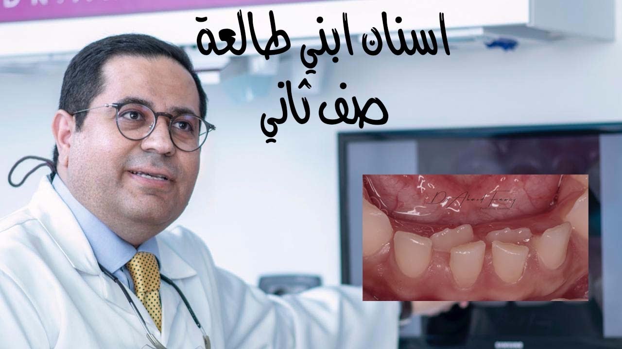 اسنان ابني الدائمة الجديدة طالعة صف ثاني ورا الاسنان اللبنية!! اعرف السبب والعلاج