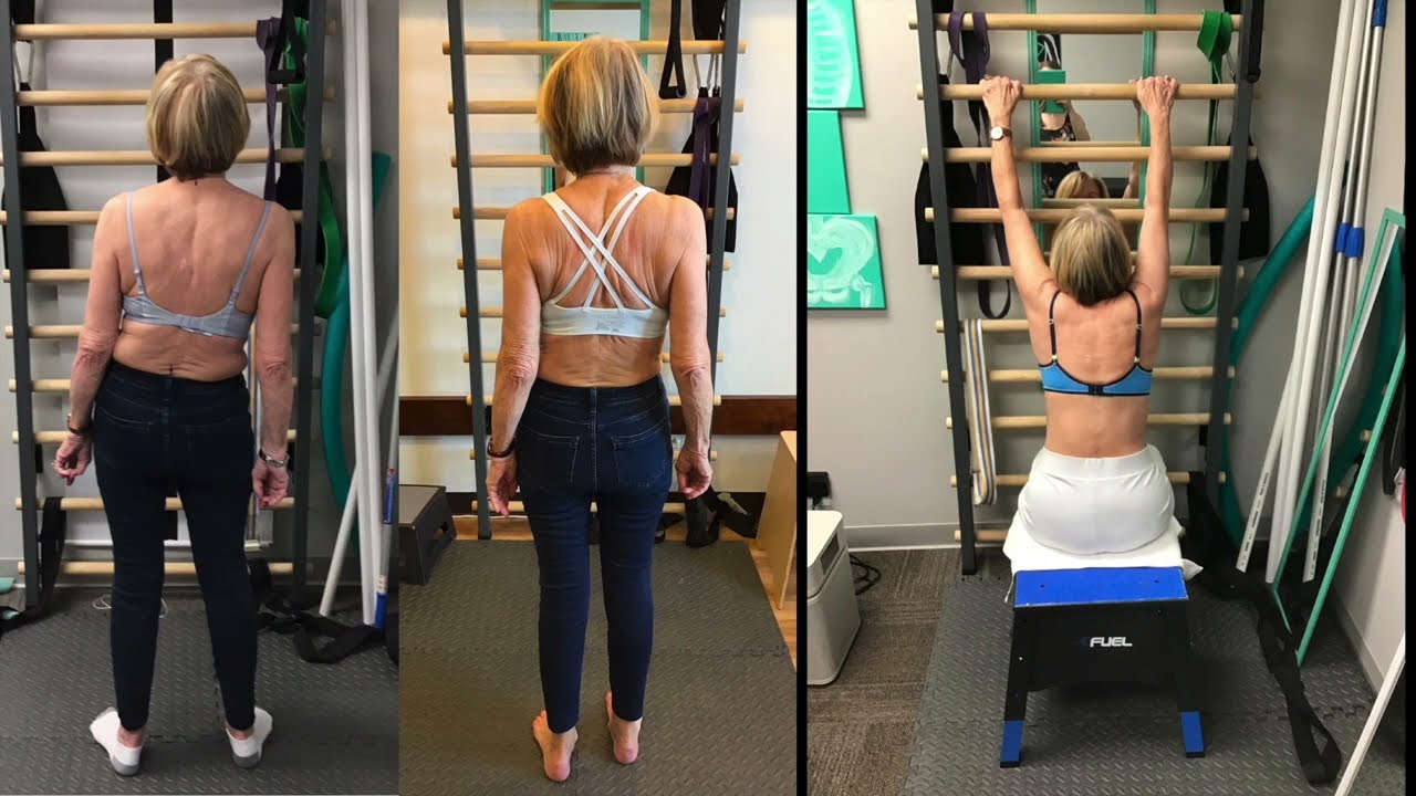Clay Scoliosis Clinic Schroth Success Stories 2022