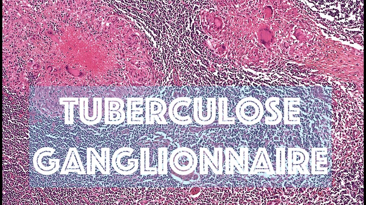 LA LYMPHADENITE TUBERCULEUSE - PATHOLOGIE