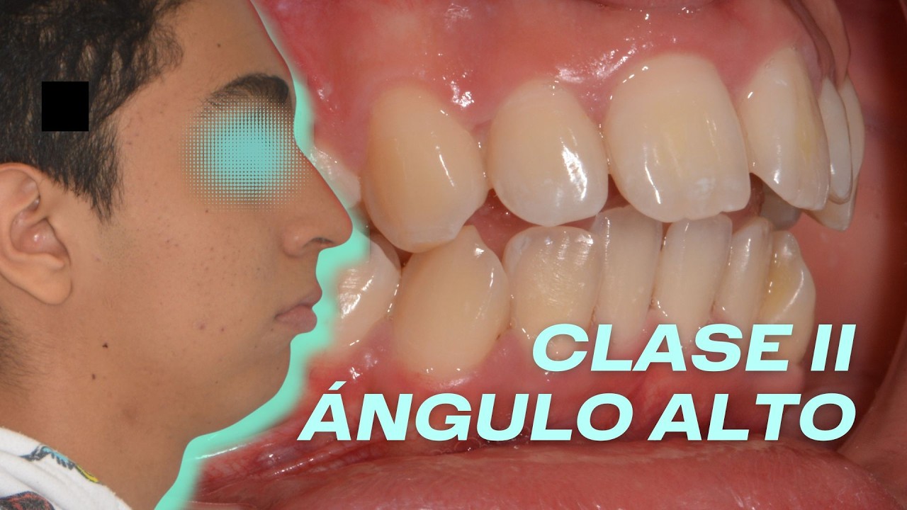Cómo es una maloclusión Clase II angulo alto