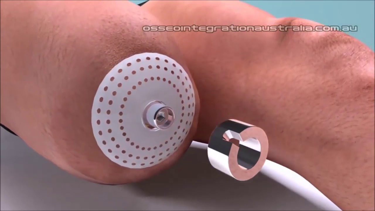 OGAP OPL Prosthesis System