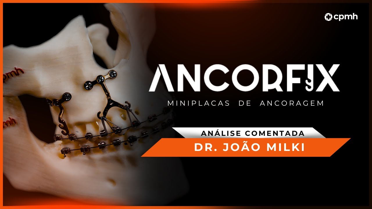 ANCORFIX | Dr. Jo&atilde;o Milki estreou as novas Miniplacas
