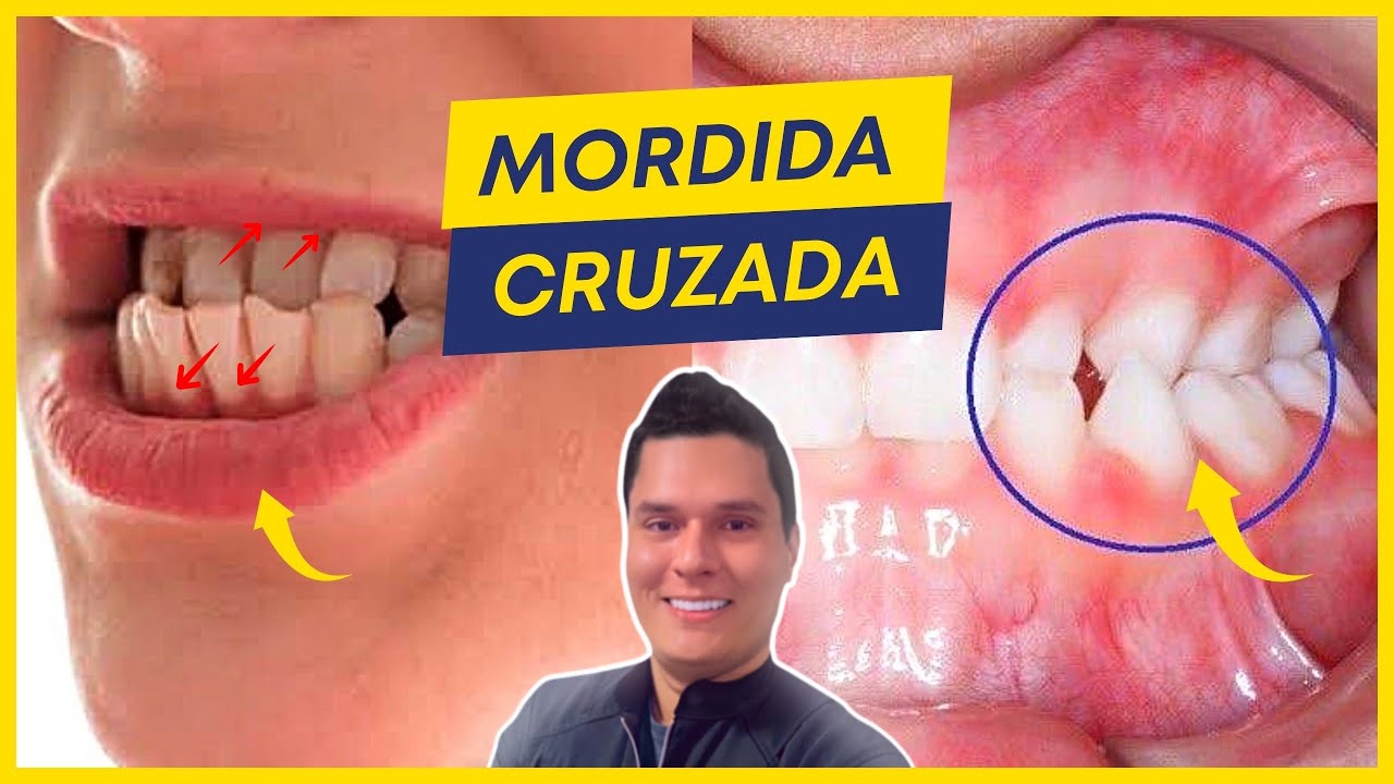 QUAL MELHOR TRATAMENTO PARA QUEM TEM MORDIDA CRUZADA?