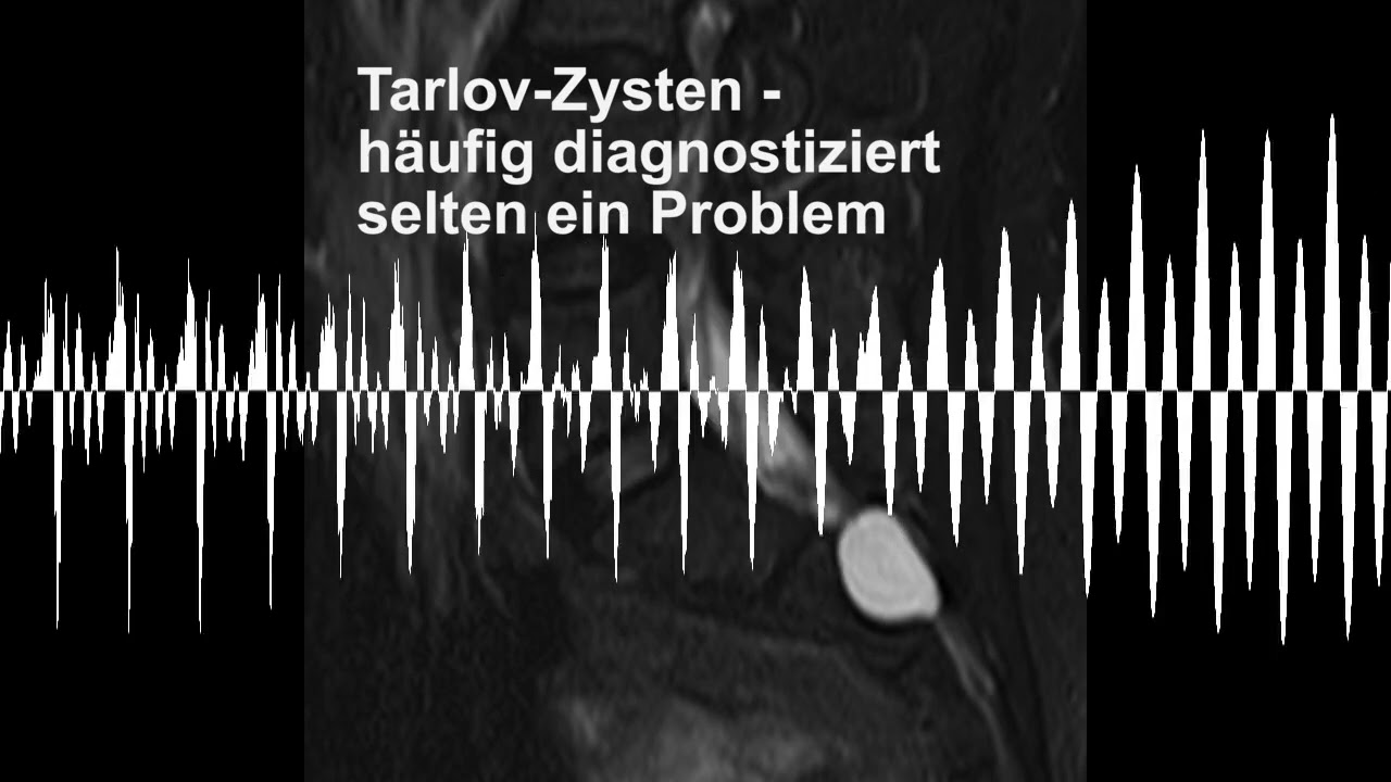 Tarlov-Zysten - häufig diagnostiziert selten ein Problem