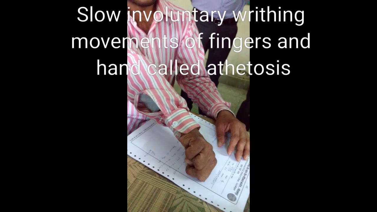 Athetosis with Dystonia