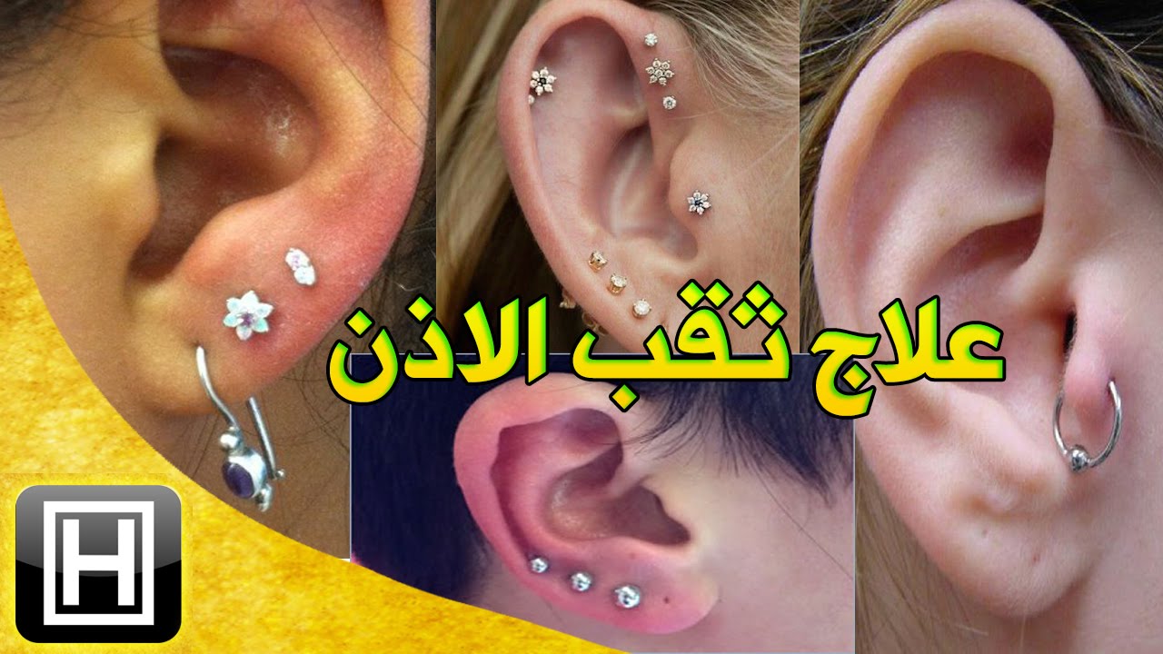 أسهل علاج للتهاب خرم الاذن أو مكان ثقب حلق الاذن وشفاء تورم الغضروف طبيعيا