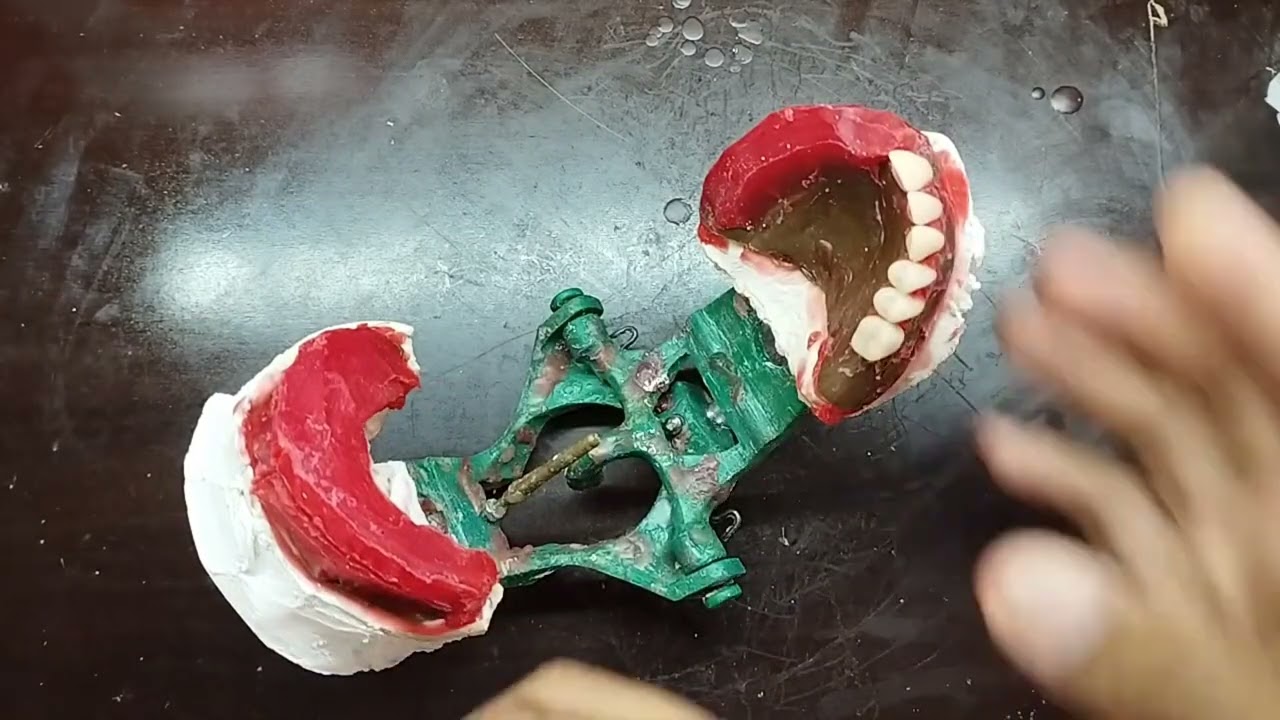 PASSO A PASSO, MONTAGEM PRÓTESE TOTAL DENTE A26
