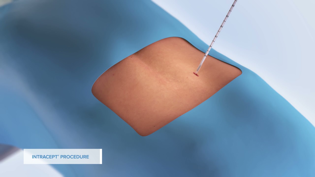 Intracept Procedure Patient Animation