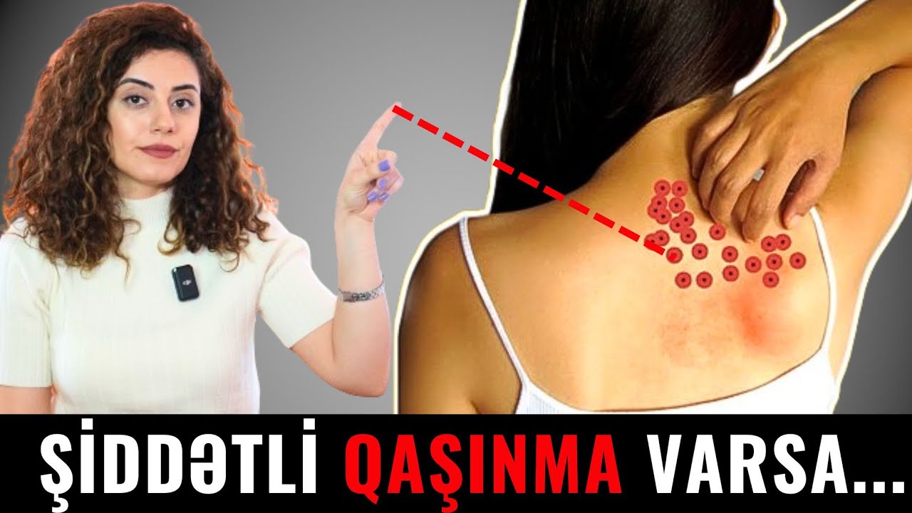 DİQQƏT! Bədəndə QAŞINMA varsa, hansı xəstəliyin xəbərçisidir?