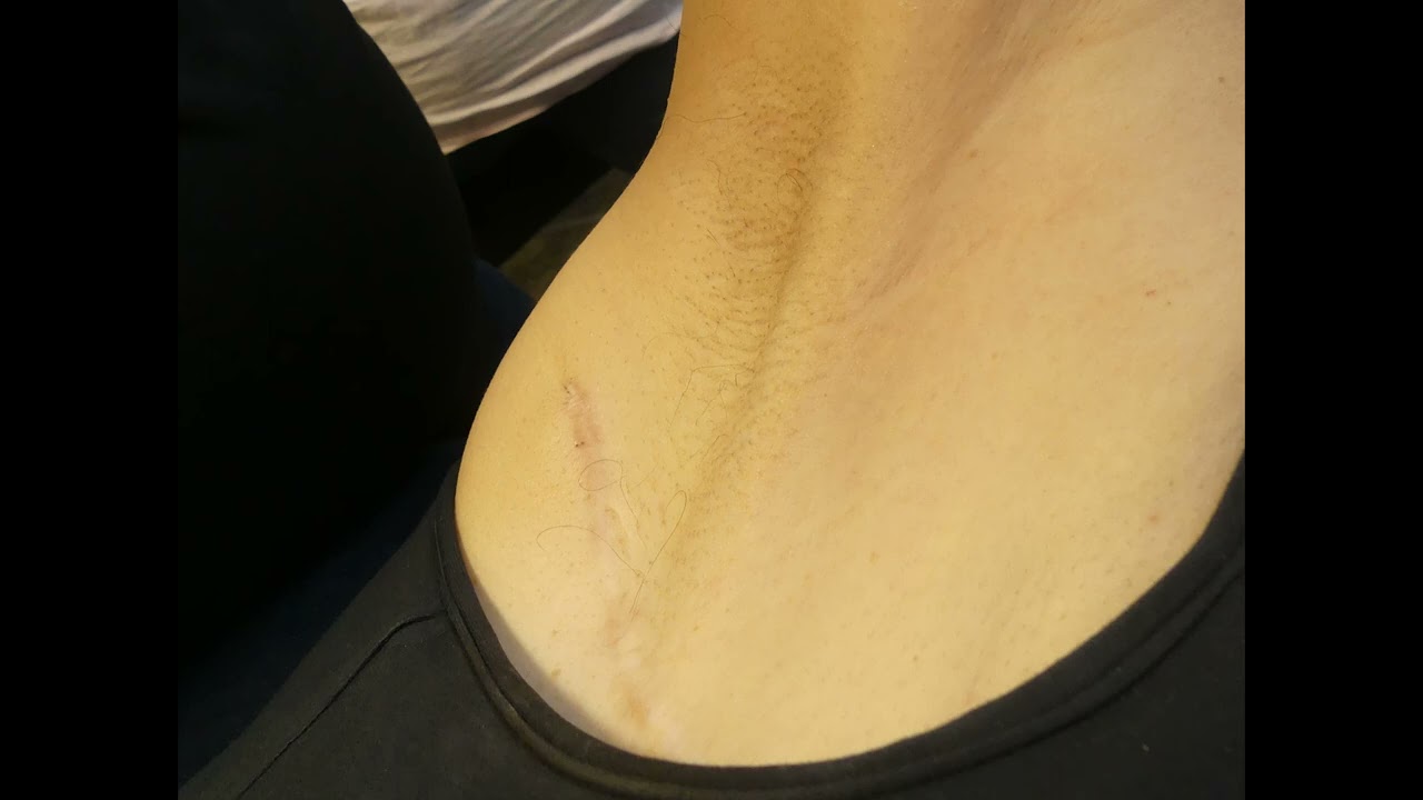 Cording and shoulder changes creates stiffness and weakness