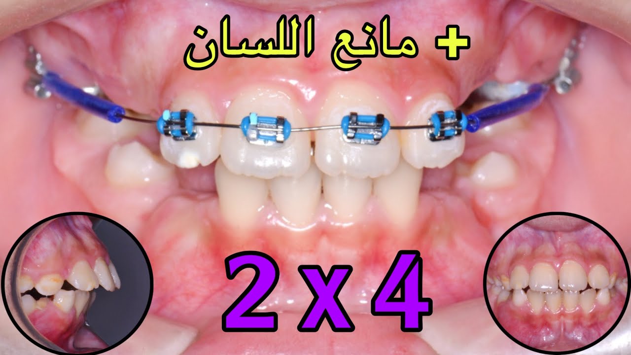 2 x 4 fixed appliance + tongue habit breaker بروز الأسنان الأمامية