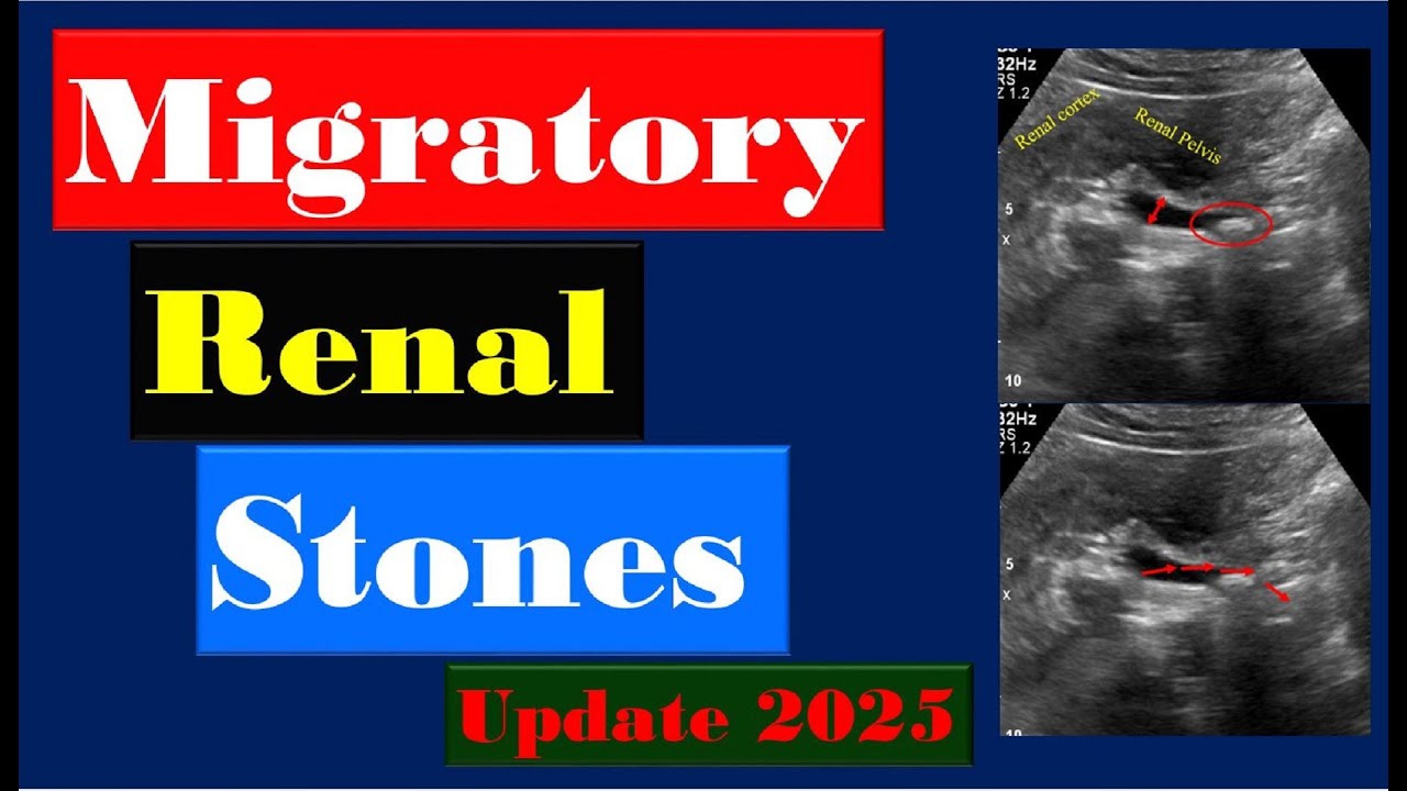 What Happens When Kidney Stones Move?