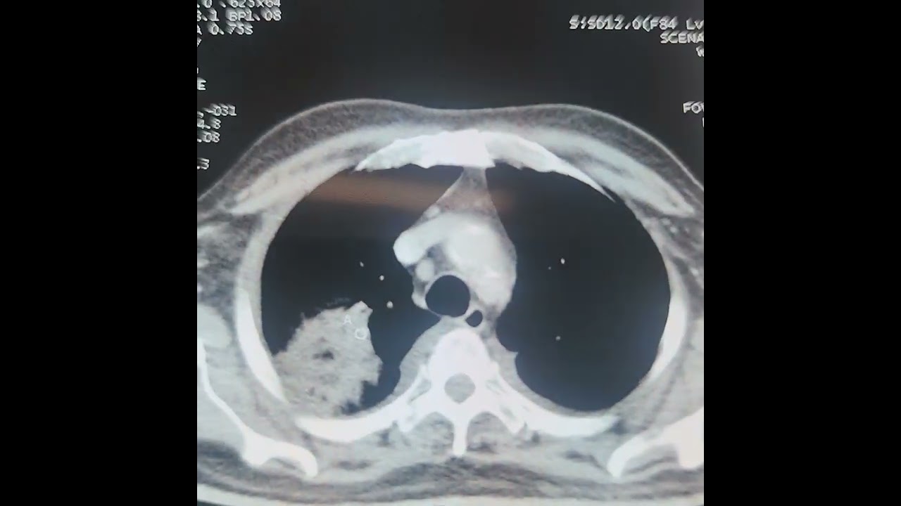 Two signs in a single nodule