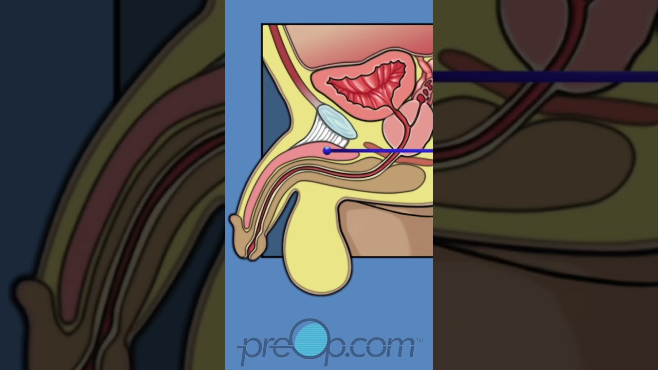 🔍 PreOp&reg; Inflatable Penis Implant Patient Ed 💡Insight That Empowers Care✨ #shorts
