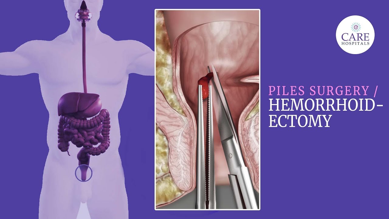 Your Ultimate Guide to Piles Surgery Hemorrhoidectomy