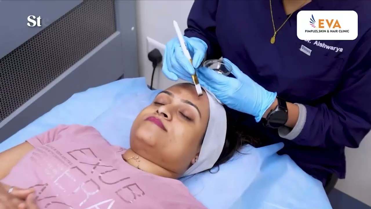 Carbon Laser Peel Complete Procedure 