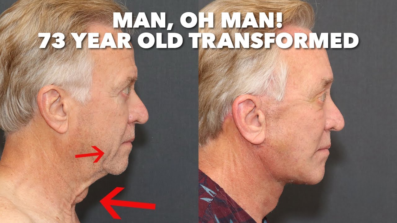 Can Men Get Facelifts? This 73 Year Old Loves the Results!