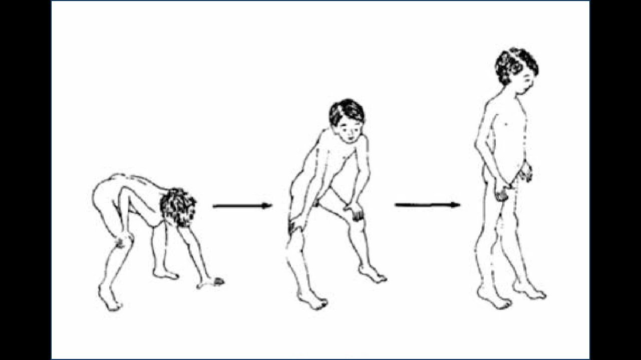 Distrofia Muscular Infantil 