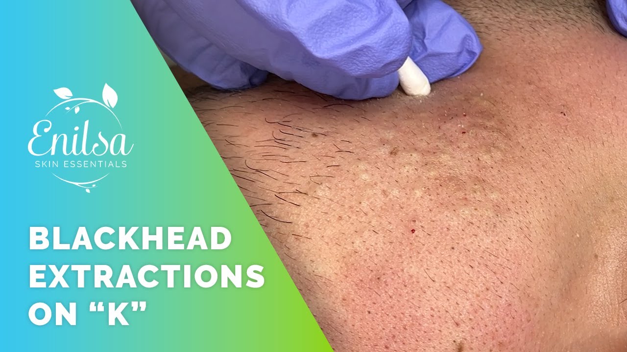 Blackhead Extrations on 