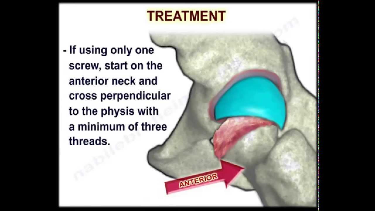 Slipped Capital Femoral Epiphysis - Everything You Need To Know - Dr. Nabil Ebraheim