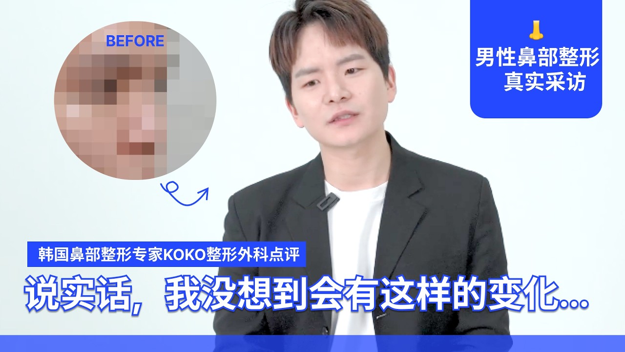 低鼻梁和朝天鼻整形后，我的人生发生了巨大的改变！ 男性鼻整形前后完美采访！