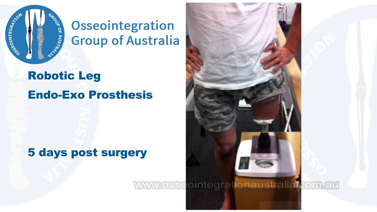 Osseointegration Patients - 5 days post surgery