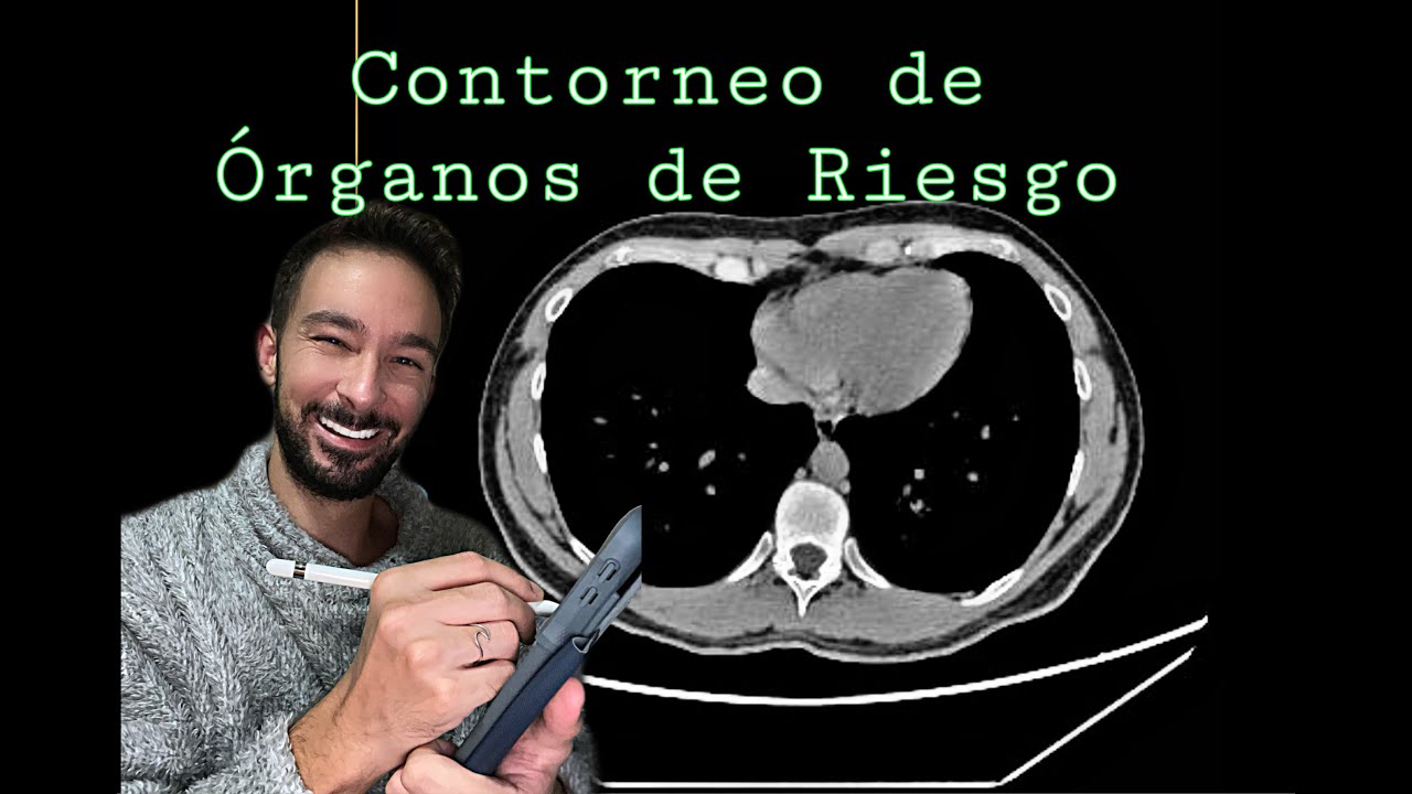 Radioterapia: Contorneo