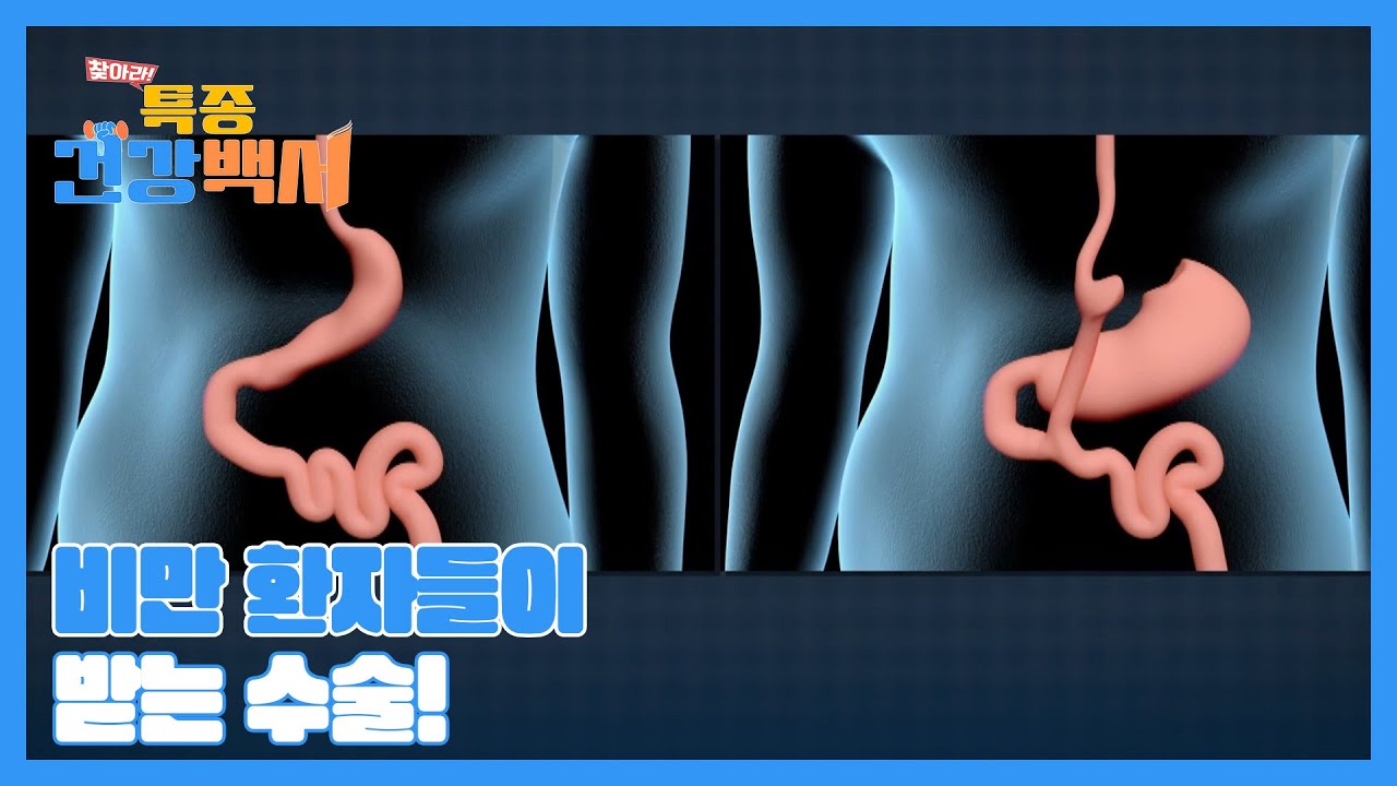 비만 환자들이 많이 받는 '위 소매 절제술', '위 우회술'! 두 수술의 차이점은? MBN 230319 방송