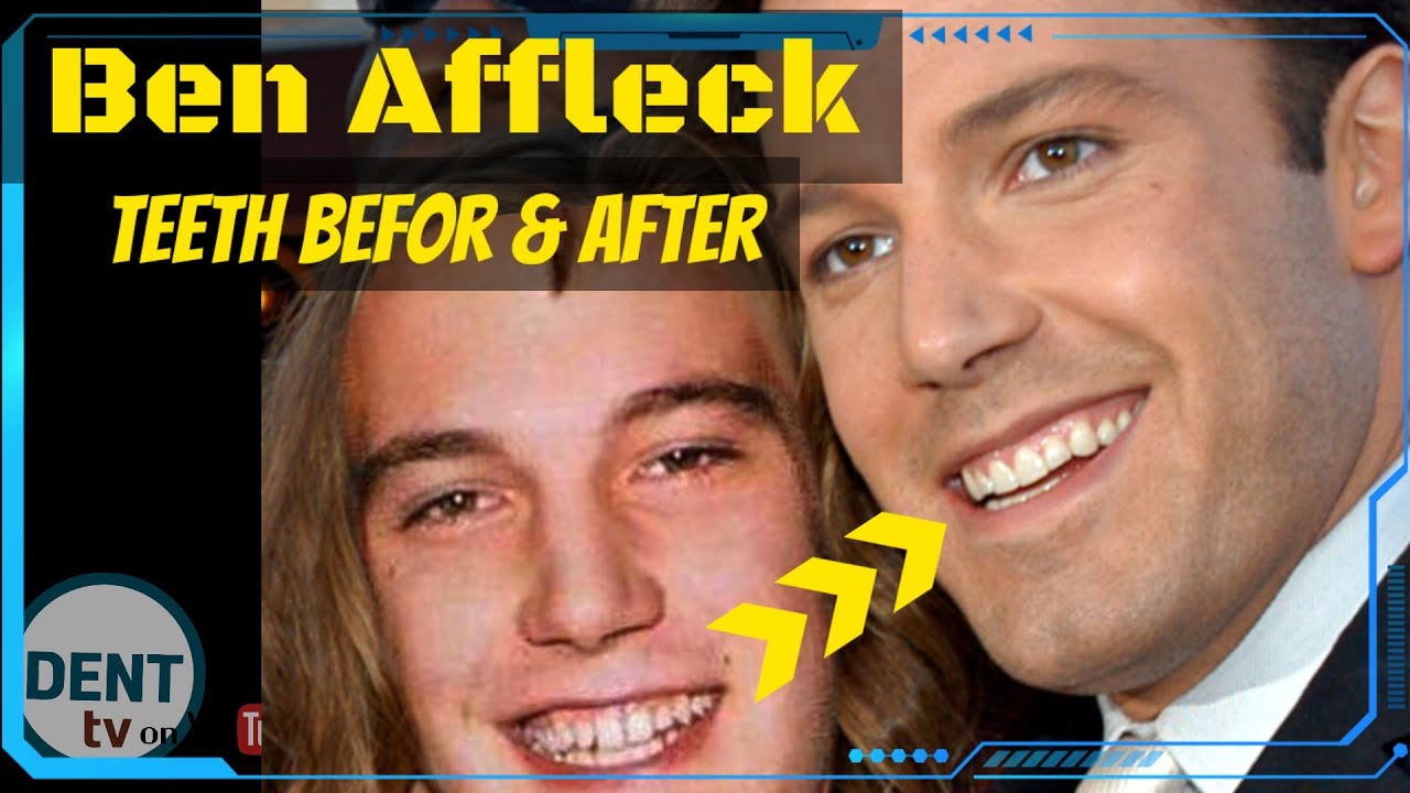 Ben Affleck teeth then and now, before and after surgery, tooth gap transformation Hollywood Veneers